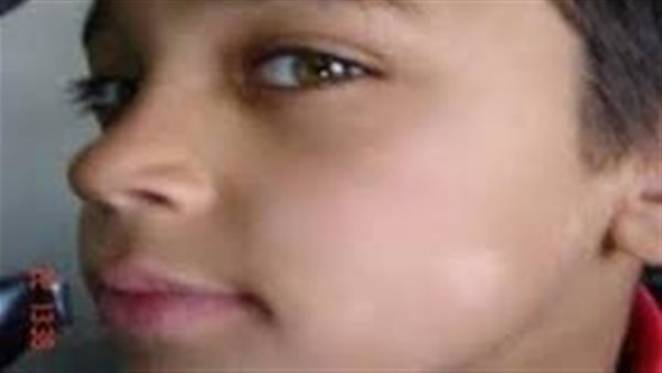 أسباب ظهور بقع بيضاء