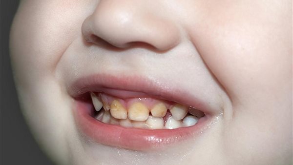 اصفرار أسنان الأطفال