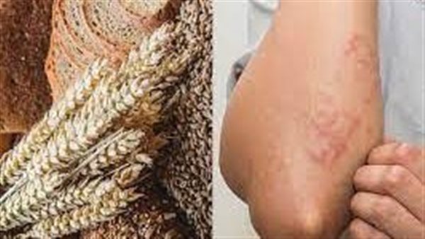 أعراض حساسية الحنطة