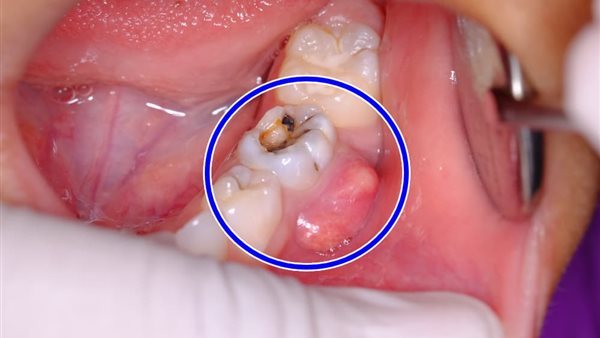 أعراض خراج الأسنان