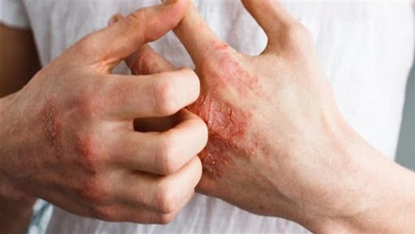 أعراض حساسية الفسيخ