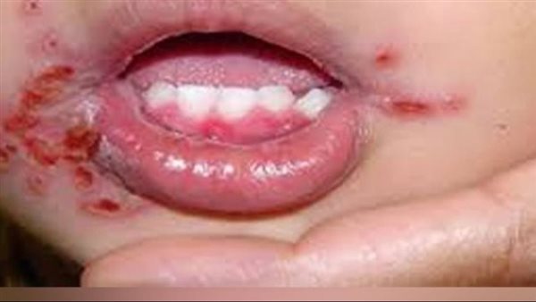 أعراض الهربس عند