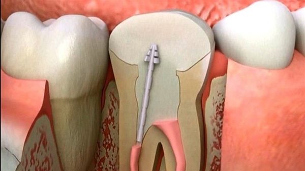 علاج جذور الأسنان
