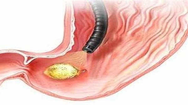 أعراض قرحة الاثنى