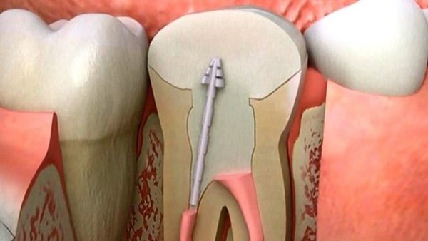 أعراض التهاب العصب