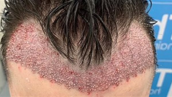 زراعة الشعر