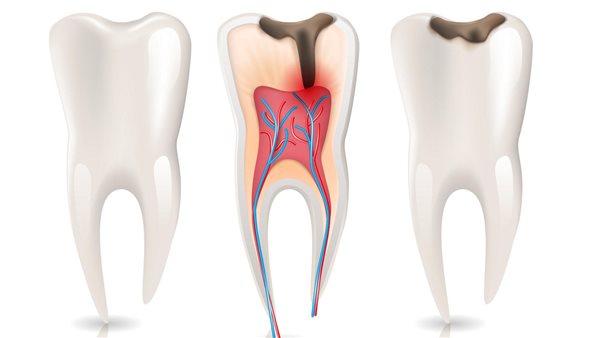 علاج التهاب عصب الاسنان