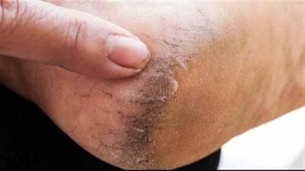أسباب تشققات الكعبين
