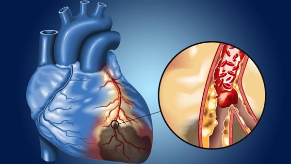 أسباب انسداد شرايين