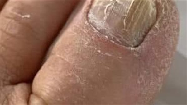 أعراض فطريات الأظافر.