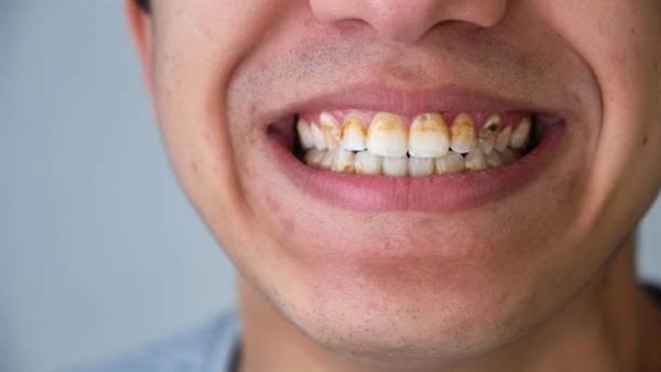 علاج تصبغ الأسنان