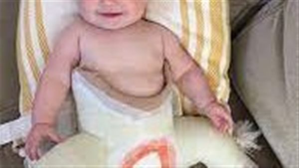 علاج خلع مفصل الورك