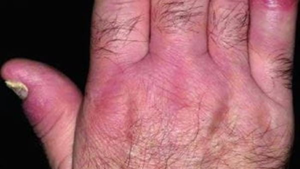 أسباب التهاب المفاصل