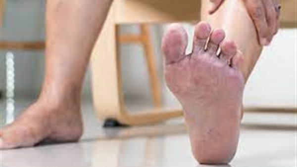 أعراض الكوليسترول