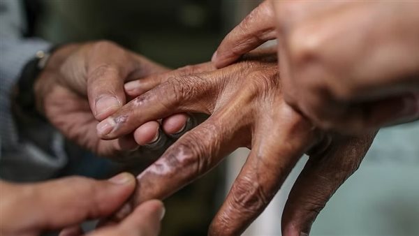 مرض الجذام