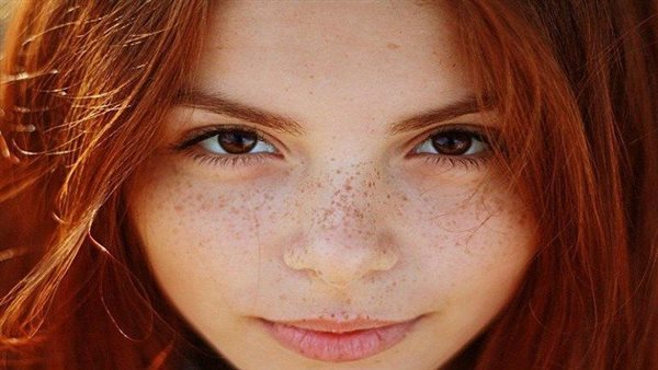 علاج النمش