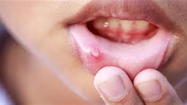 نصائح لعلاج الهربس