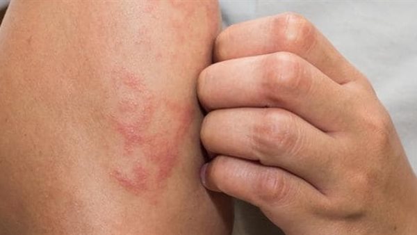 اعراض نقص فيتامين