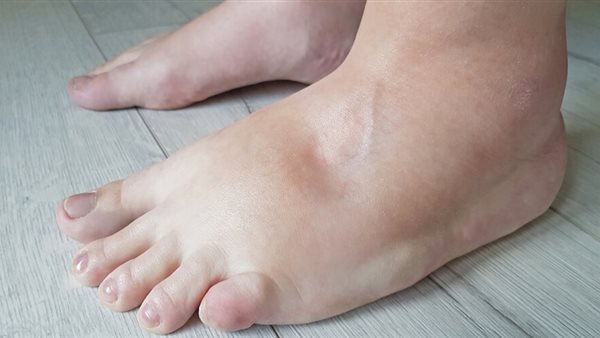 احتباس السوائل في