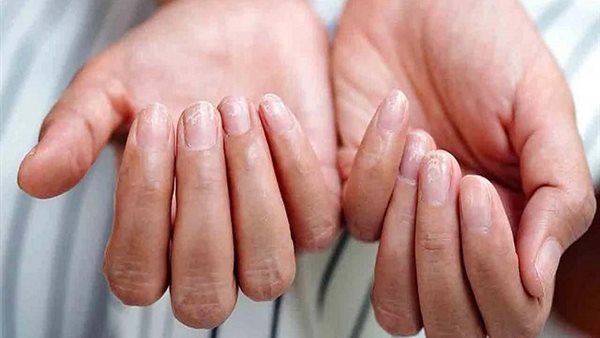من أعراض نقص الحديد