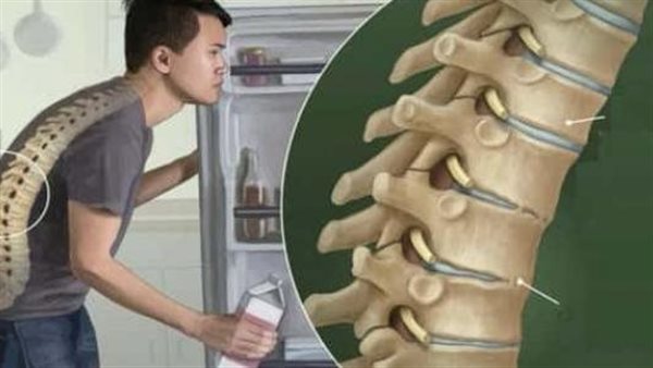 أعراض التهاب الفقار