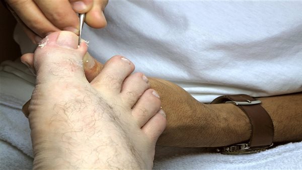 هل يمكن علاج الظفر