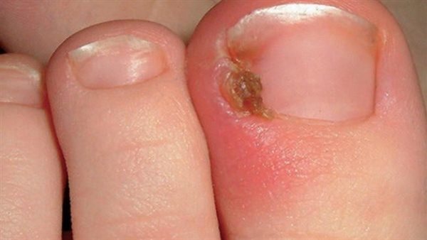 طرق الوقاية من الظفر