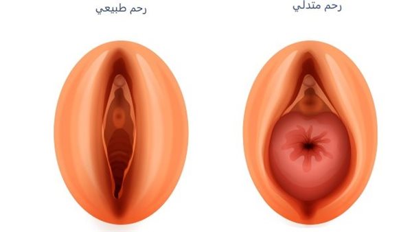 ما هو هبوط الرحم؟