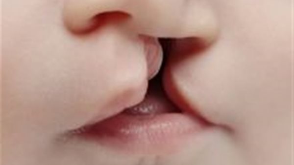 تشوه الأجنة