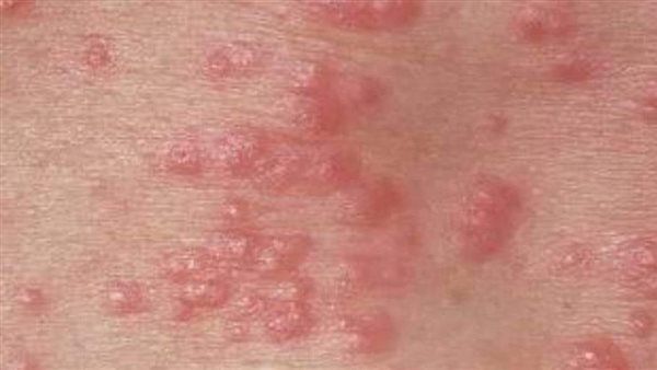 طرق الوقاية من الجرب