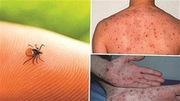 طرق الوقاية من الحمى