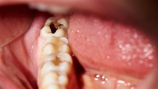 أعراض ضرس العقل المدفون