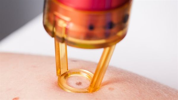 طرق علاج السنط الجلدى
