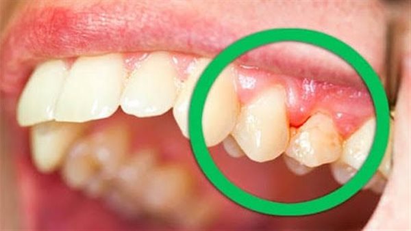 علاج التهاب دواعم