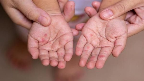 أعراض الحمى القلاعية