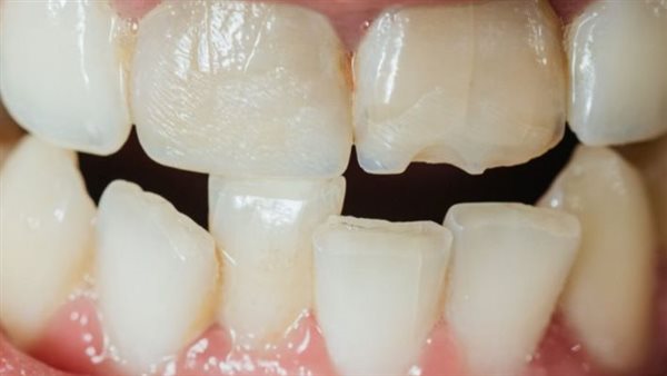 علاج تفتت الأسنان