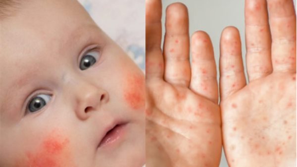 امراض تسبب الطفح