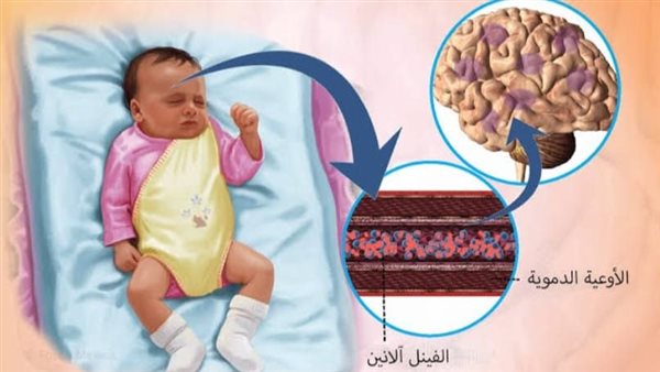 مرض PKU