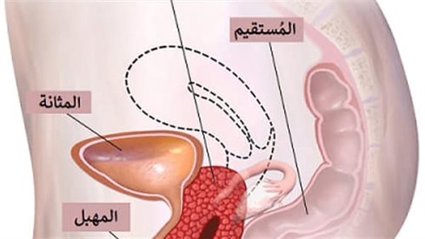 أعراض سقوط الرحم