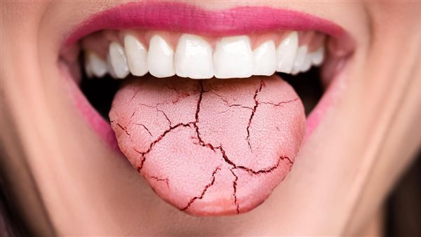 علاج جفاف الفم بأدوية