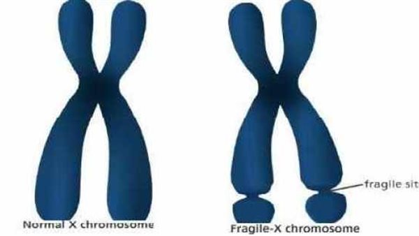 متلازمة X الهشة