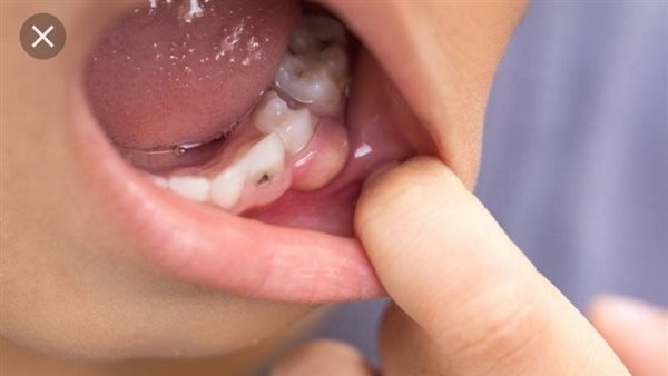 أخطر أنواع تسوس الأسنان