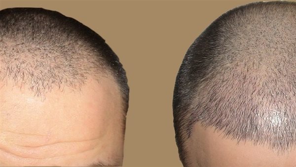 اضرار زراعة الشعر