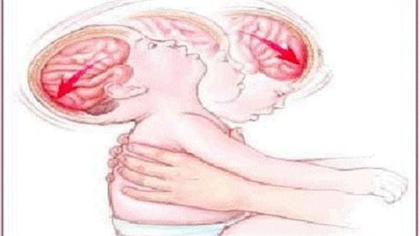 متلازمة هز الرضيع