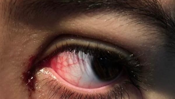 مخاطر الألعاب النارية