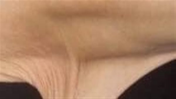 أعراض متلازمة إهلرز