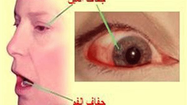 متلازمة شوغرن