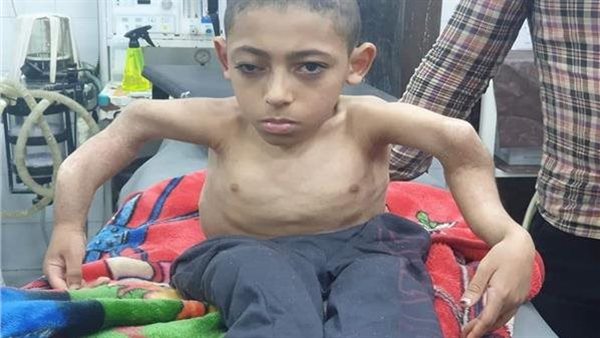 أعراض مرض العظم الزجاجي