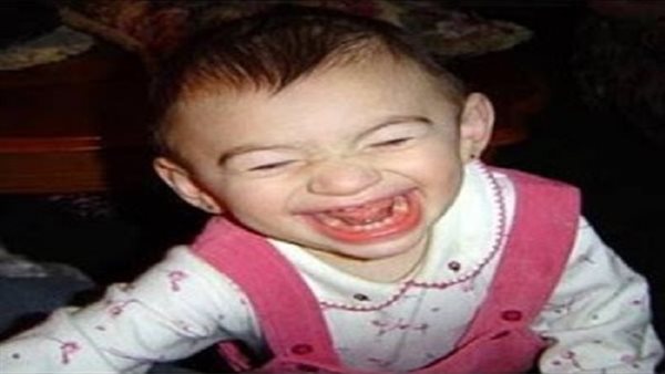 تشخيص متلازمة أنجلمان