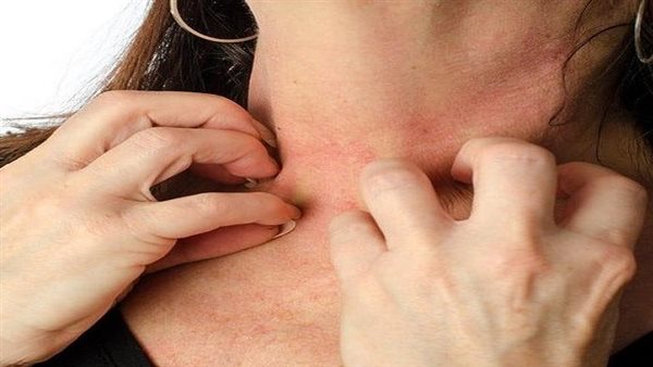 أعراض قمل الجسم